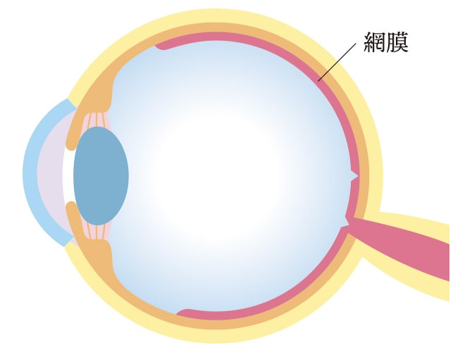 網膜疾患のイメージ画像